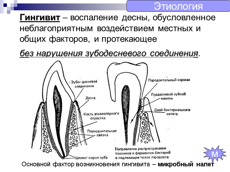 Гингивит – воспаление десны, обусловленное неблагоприятным воздействием местных и общих факторов, и протекающее 